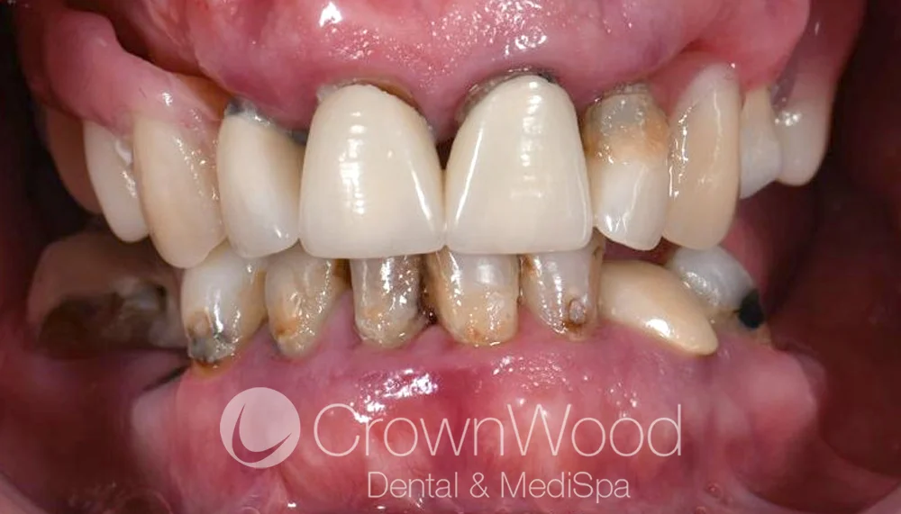 Teeth in a day restored this patients confidence