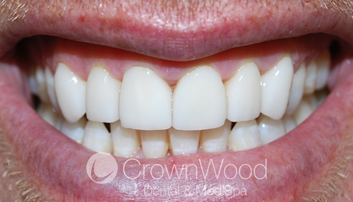 After Dental Veneers Bracknell