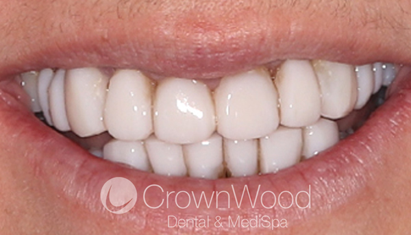 After Composite Veneers at CrownWood Dental