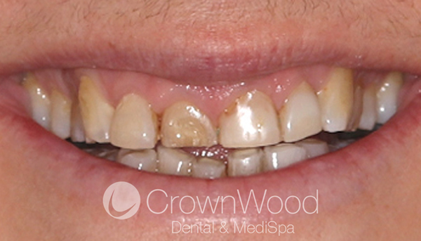 Before Composite Veneers at CrownWood Dental