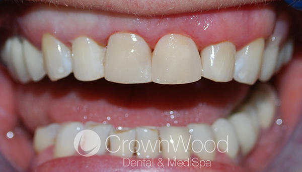 Dental Veneers After