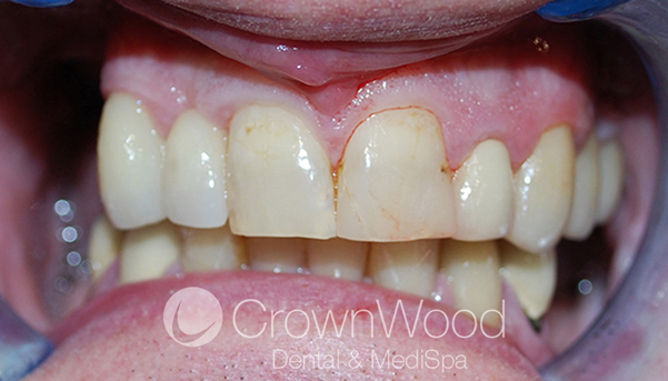 Dental Veneers After