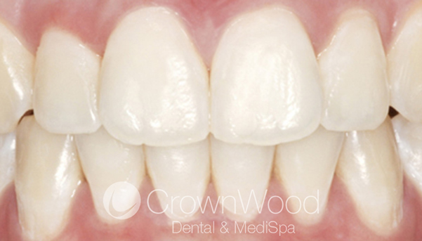 Icon white spot treatment results