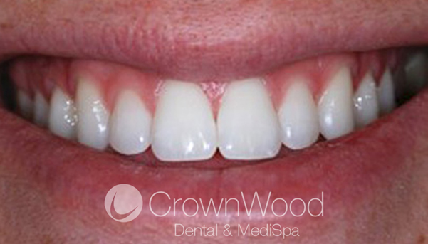 Teeth whitening in Berkshire - Laser whitening after