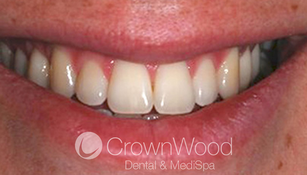 Teeth whitening in Berkshire - Laser whitening before