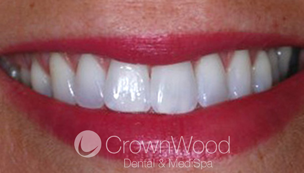 After Laser and Home Whitening