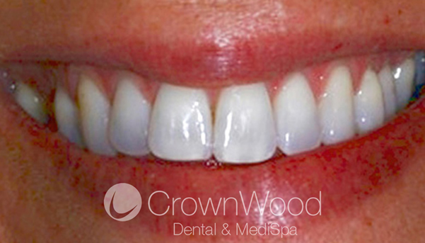 Before Laser and Home Whitening