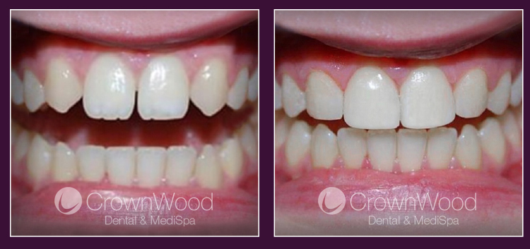 Composite Bonding at CrownWood Dental Bracknell