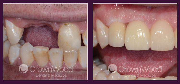 Dental Implants at CrownWood Dental Bracknell