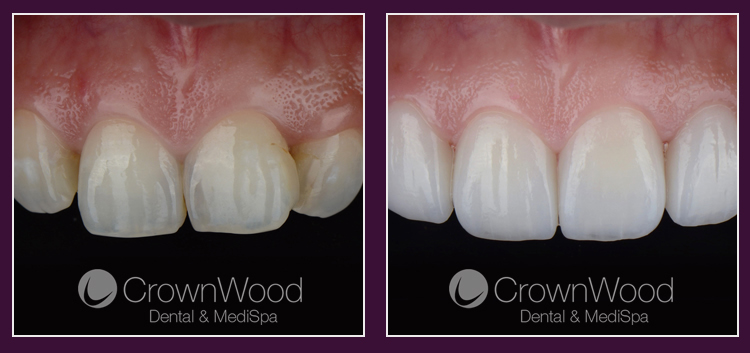 Dental Veneers Bracknell at CrownWood