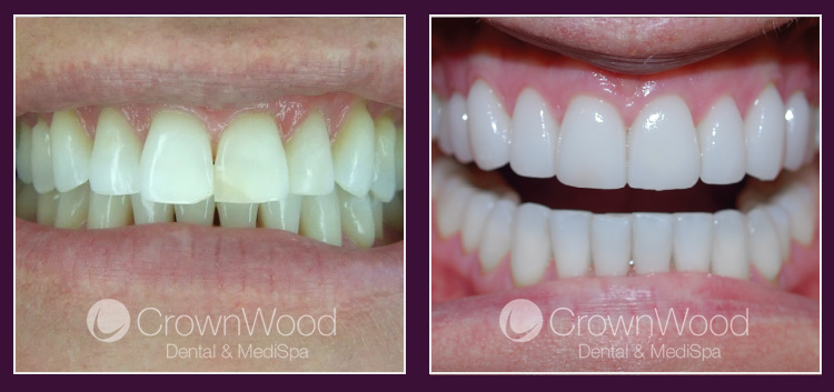 Smile Makeovers at CrownWood Dental Bracknell