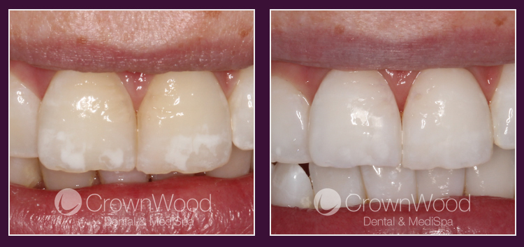 Icon White Spot Treatment at CrownWood Dental Bracknell