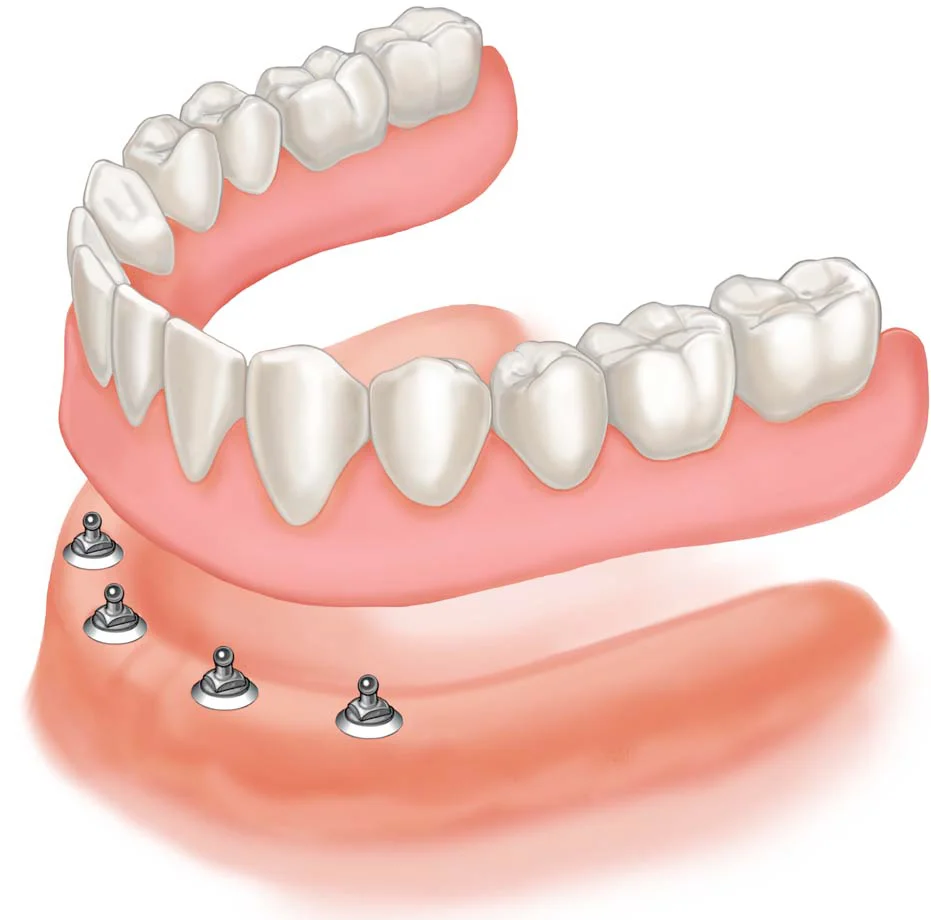 Overbite