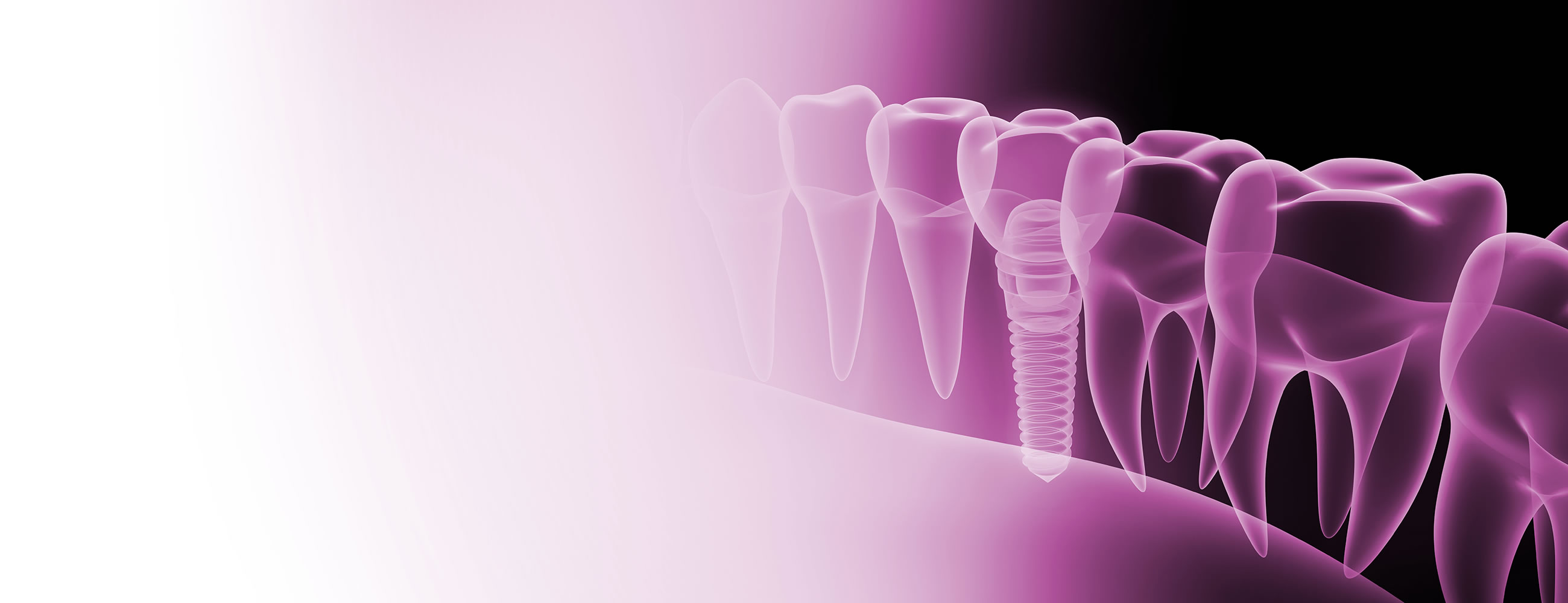 Dental Implant Referrals in Bracknell