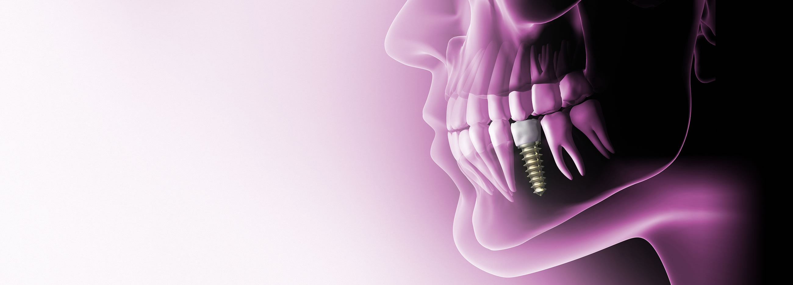 Dental Implants near me Bracknell