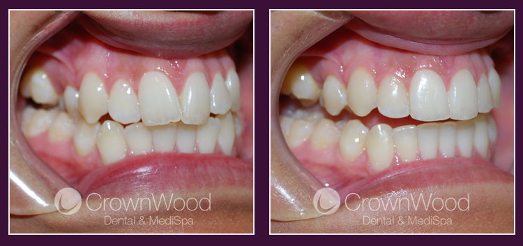 Invisalign at CrownWood Dental Bracknell