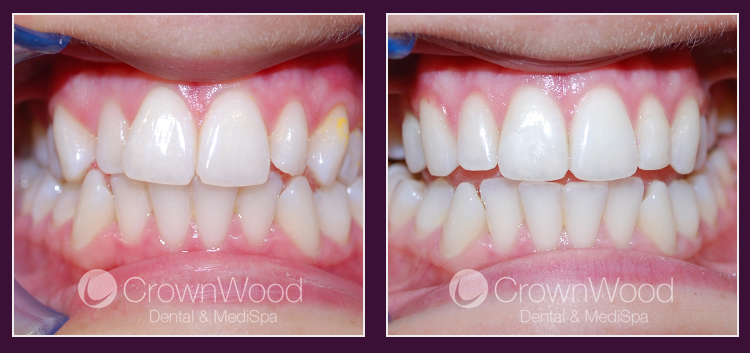 Invisalign Lite at CrownWood Dental Bracknell