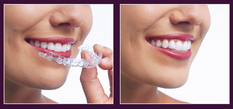 Invisalign Teen at CrownWood Dental Bracknell