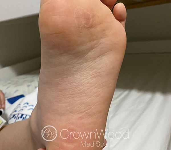 After Wart Treatment at CrownWood MediSpa