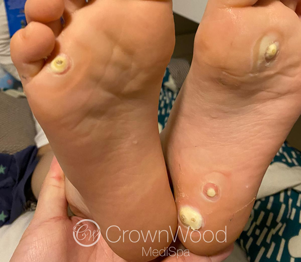 Before Wart Treatment at CrownWood MediSpa