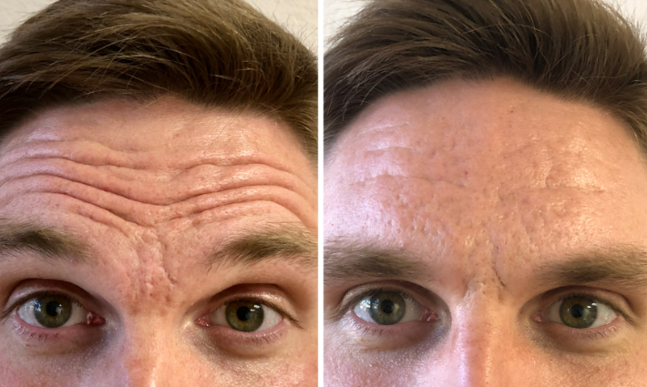 Botox before & after treatment in Bracknell