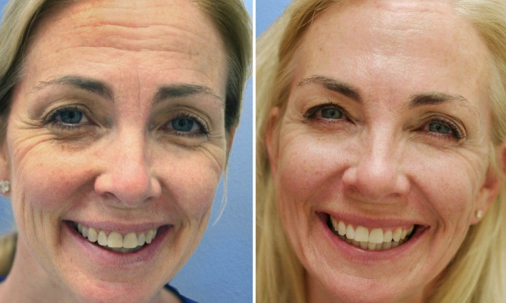 Botox before & after treatment Berkshire, UK