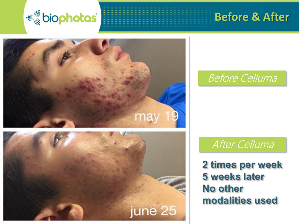 Celluma pro before after acne treatment