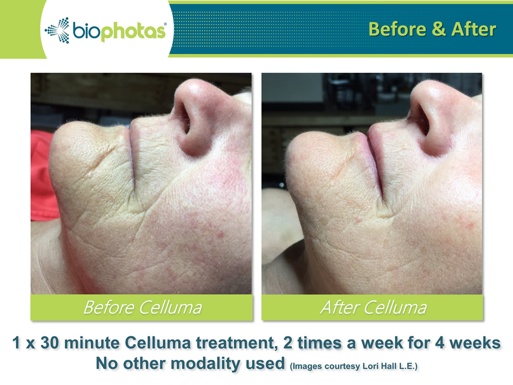 Celluma pro before after anti-aging treatment