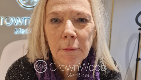 After dermal fillers with Dr Raj