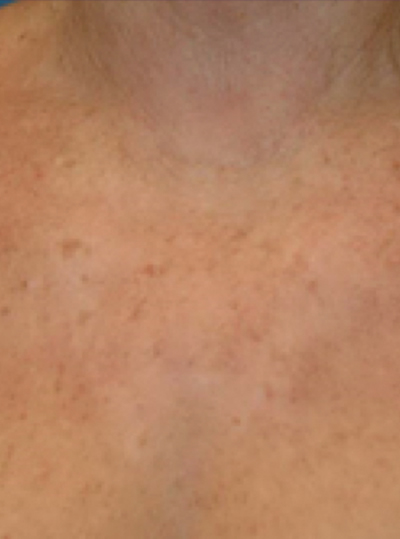 After Pigmentation Treatment in Berkshire