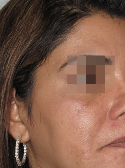 Laser Skin Resurfacing Bracknell, Berkshire