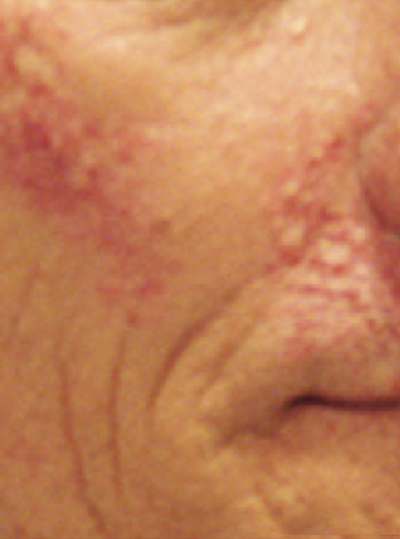 After Laser Skin Resurfacing