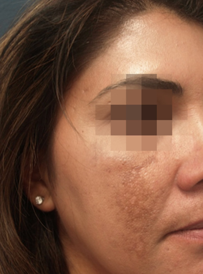 Before Laser Skin Resurfacing