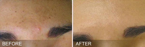 Before and after image showing how HydraFacial can treat brown spots