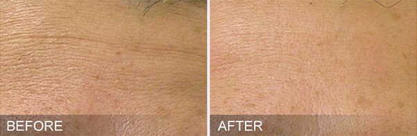 Before and after image showing how HydraFacial can treat fine lines