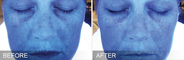 Before and after image showing how HydraFacial can increase hydration