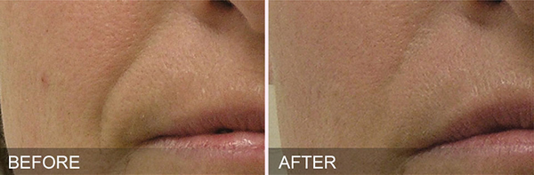 Before and after image showing how HydraFacial can treat nasolabial folds