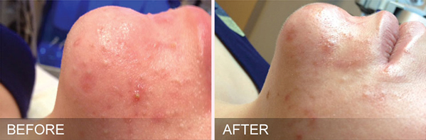 Before and after image showing how HydraFacial can treat oily congestion