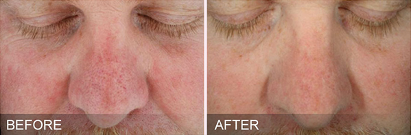 Before and after image showing how HydraFacial can treat sun damage