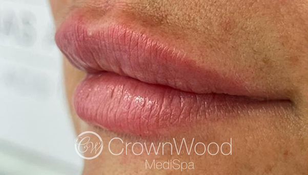 Lip Fillers - After Treatment by Dr Victoria Jaminson