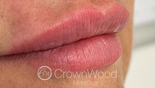 After Lip Fillers by Dr Victoria Jaminson