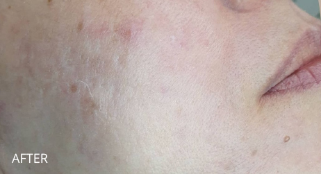 After Microneedling by Alice Hau