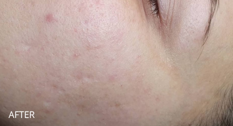 After microneedling in Berkshire by Alice Hau at CrownWood