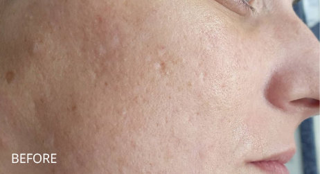 Before Microneedling by Alice Hau