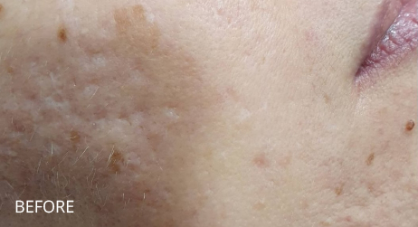 Before Microneedling by Alice Hau