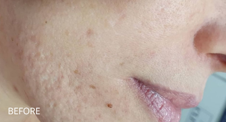 Before Microneedling by Alice Hau at CrownWood