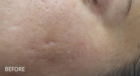 Before Microneedling by facial therapist Alice Hau