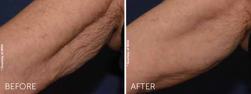 Profhilo before & after arm treatment