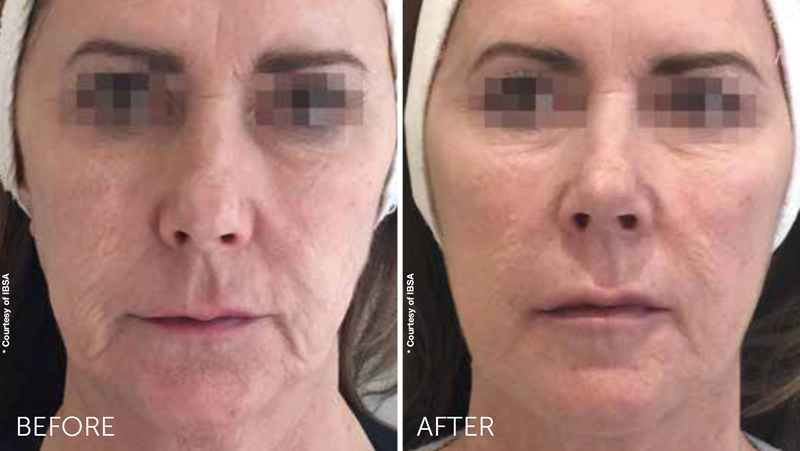 Profhilo before & after full face treatment