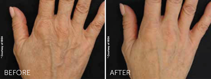 Profhilo before & after hand treatment
